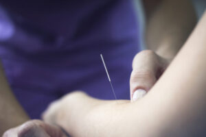Dry Needling Austin, TX